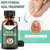 Anti Fungal Nail Treatment Nail Finger Toe Fungus Onychomycosis Remover